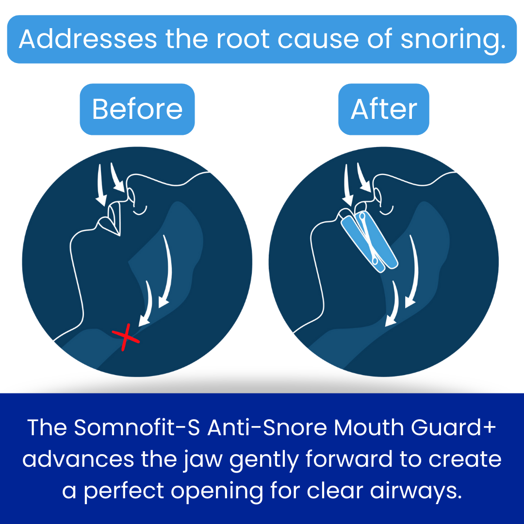 Somnofit-S addresses the root cause of snoring