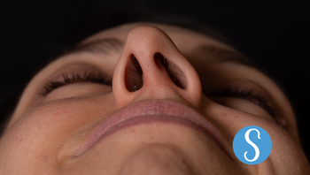 A woman with a deviated septum