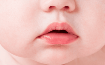 Image of a mouth breathing toddler