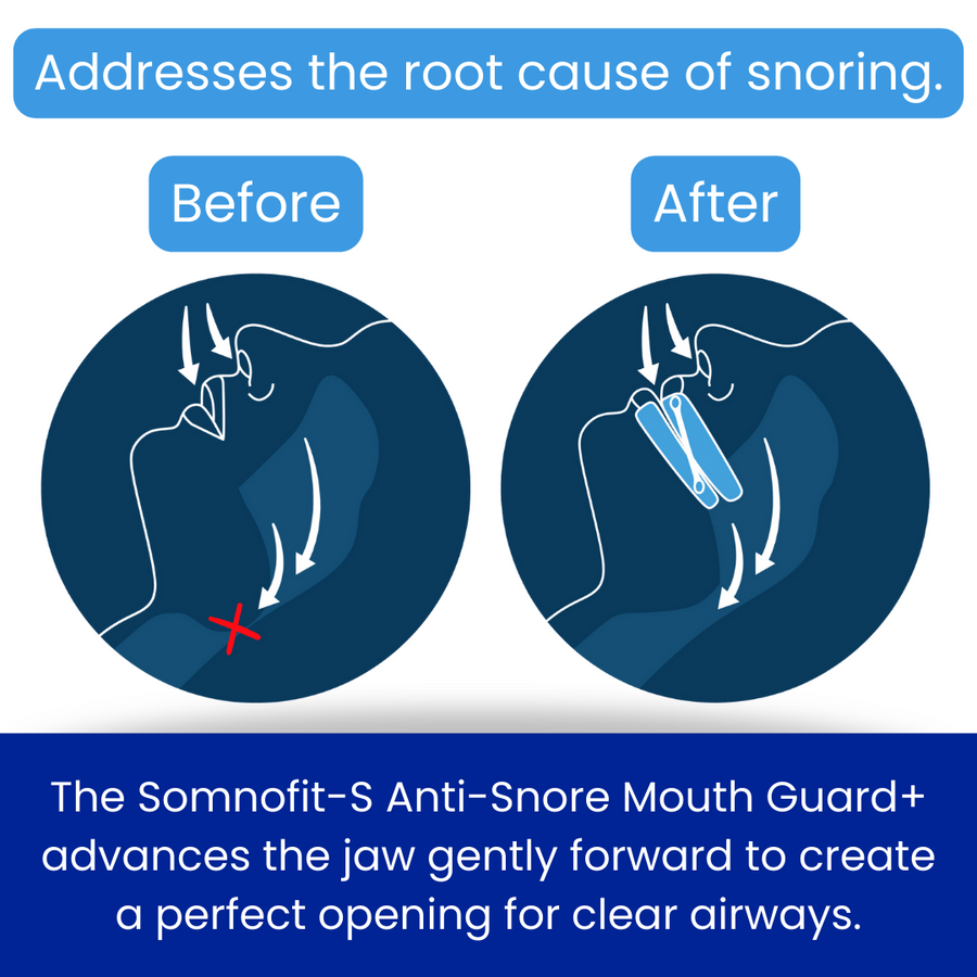 Somnofit S Anti Snore Mouth Guard Snorelessnow